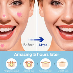 Acne Patch Pimple Cover Hydrocolloid Patches - Pink Star&heart Shaped