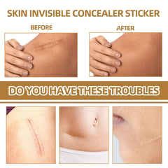 60pcs Invisible Concealer Stickers For Scars Acne Marks Waterproof Skin Tone