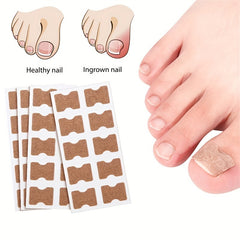 Ingrown Toenail Correction Stickers for Men and Women Foot Care Patch