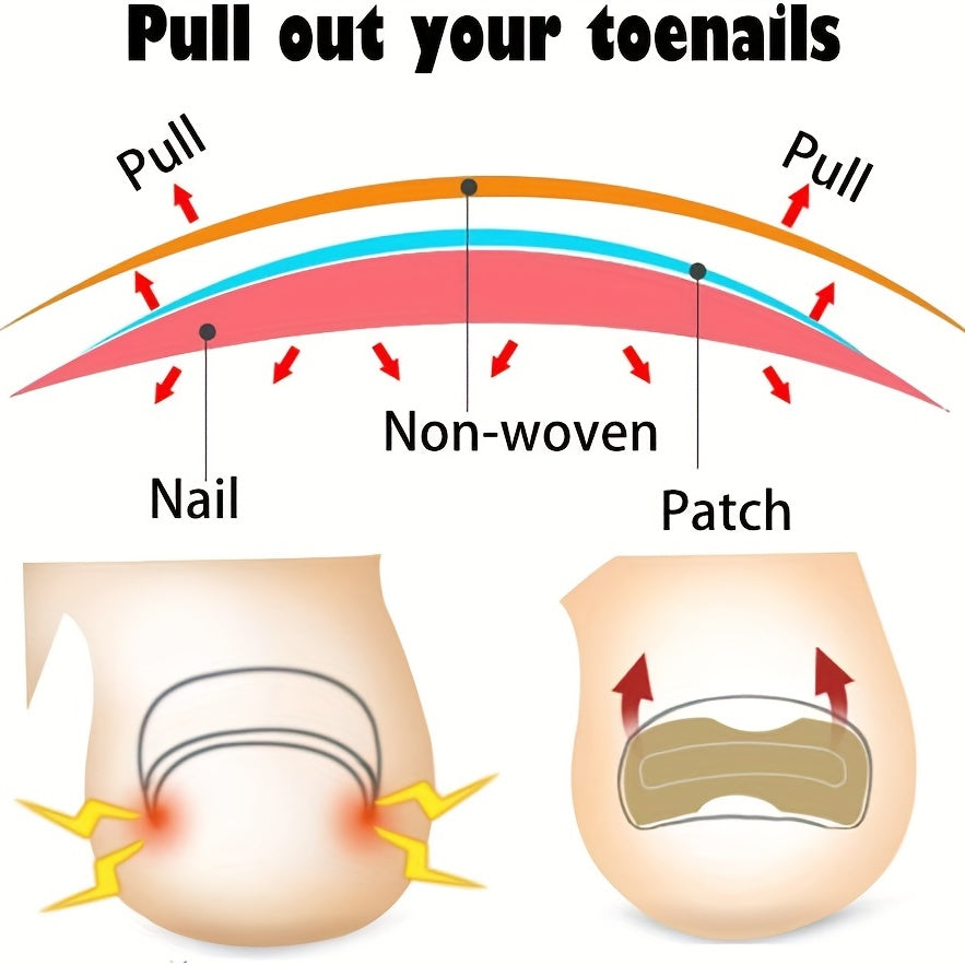 Ingrown Toenail Correction Stickers for Men and Women Foot Care Patch