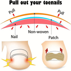 Ingrown Toenail Correction Stickers for Men and Women Foot Care Patch