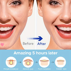 Acne Patch Pink Heart Shaped Hydrocolloid Acne Patches For Face