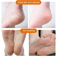 Anti Crack Cream for Feet - Softens Dead Skin and Calluses - 50g