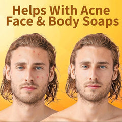 Africa Soap Bar for Acne Eczema Psoriasis Scar Removal
