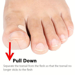 Ingrown Toenail Removal Kit Glue Patches for Pain Relief