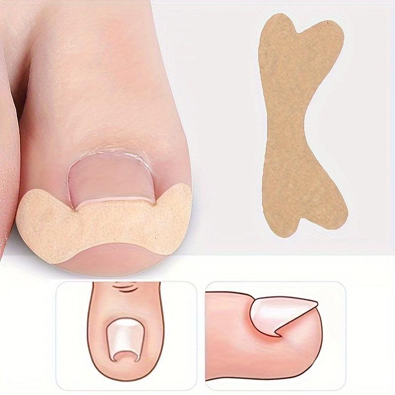 Ingrown Toenail Removal Kit Glue Patches for Pain Relief