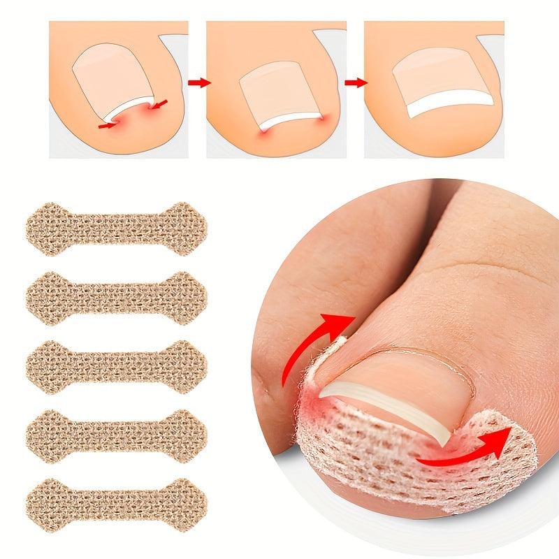 Ingrown Toenail Patch Nail Correction Sticker - Paronychia Straightening