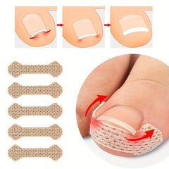 Ingrown Toenail Patch Nail Correction Sticker - Paronychia Straightening