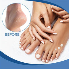 Urea Cream 30ml Foot Cream - Moisturizer for Heels, Knees, Elbows & Hands
