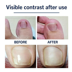 Ingrown Toenail Corrector Sticker Nail Strip Anti Roll Nail Glue Toe Inlay