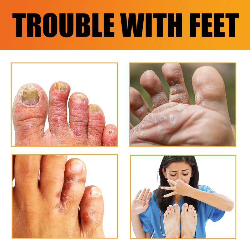2pcs Athlete's Foot Cream Prevent Chapping Soothes Itching
