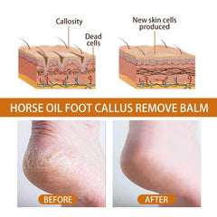 Callus Removal Balm for Dry Skin Softening