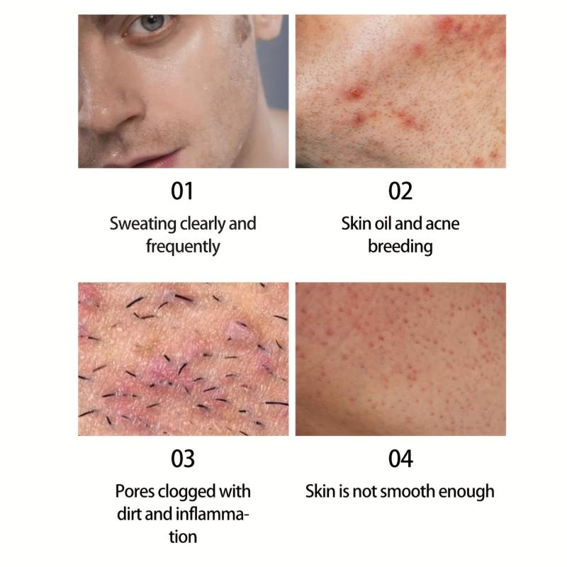 Acne Dark Spot Soap Bar for Face Body Cleansing Bath