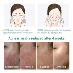 Herbotany Acne Pimple Salicylic Acid Fade Spot Treatment