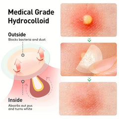 144 Pcs Hydrocolloid Acne Patches - Waterproof Pimple Patches