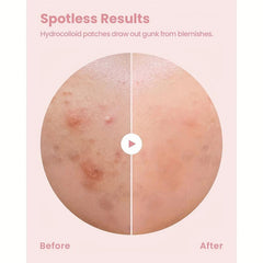 144 Pcs Hydrocolloid Acne Patches - Waterproof Pimple Patches