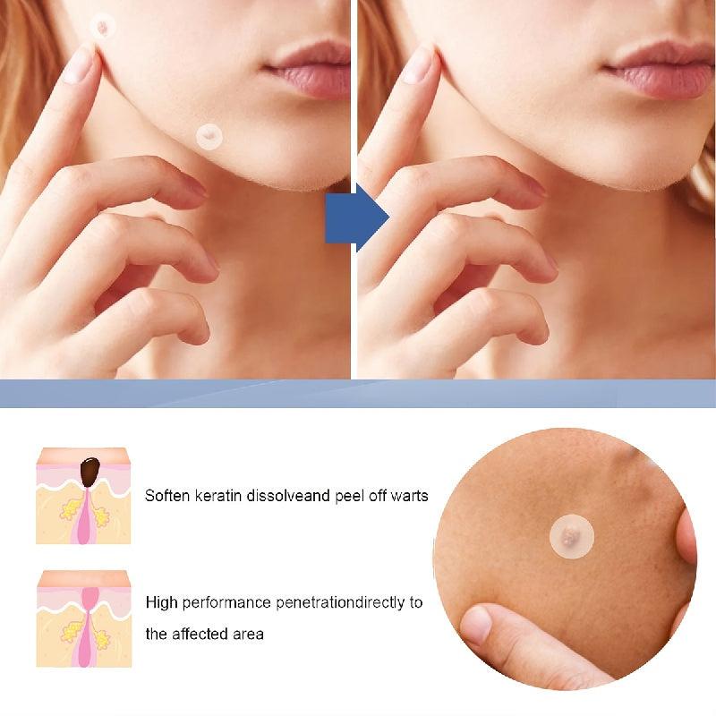 Hydrocolloid Acne Patches 360pcs, Daily Skin Care for Pimples and Blemishes