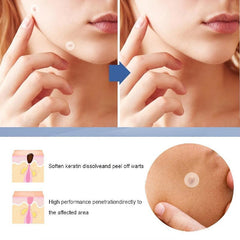 Hydrocolloid Acne Patches 360pcs, Daily Skin Care for Pimples and Blemishes