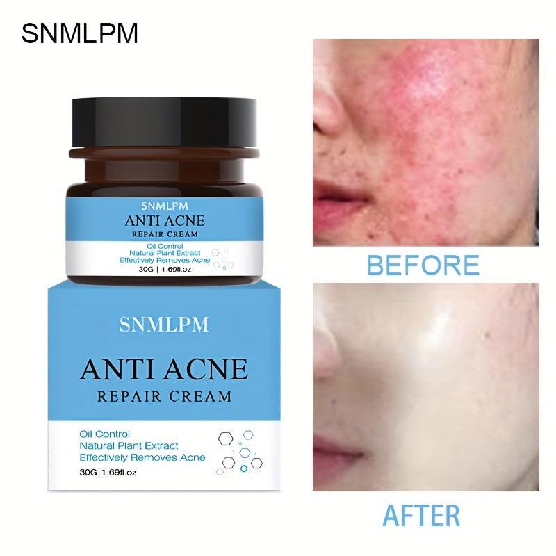 Acne Marks Scars Removal Repair Cream