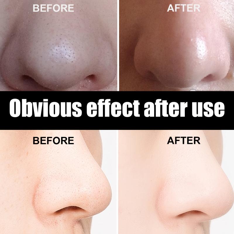 2pcs 30g Blackhead Removal Nasal Mask Removes Dirt and Acne with 60 Sheets