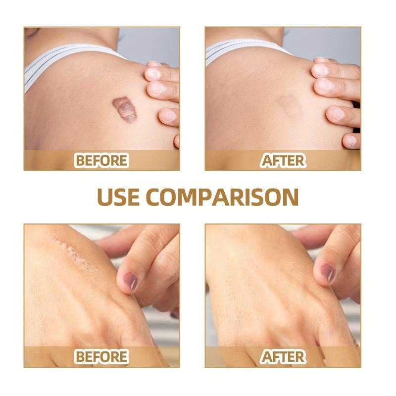 Skin Invisible Concealer Sticker Scar Tattoo Cover Up Waterproof
