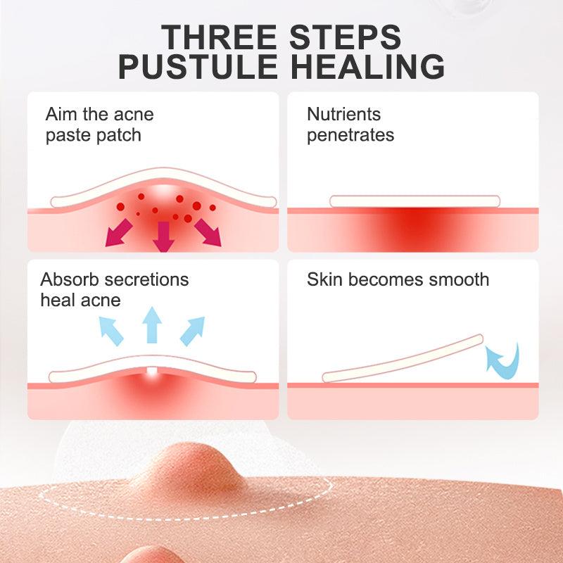 24 Pcs Invisible Acne Patch Skin Acne Removal Patch Waterproof