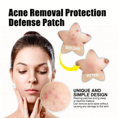60pcs Acne Removal Patchs Invisiable Covering Tea Tree