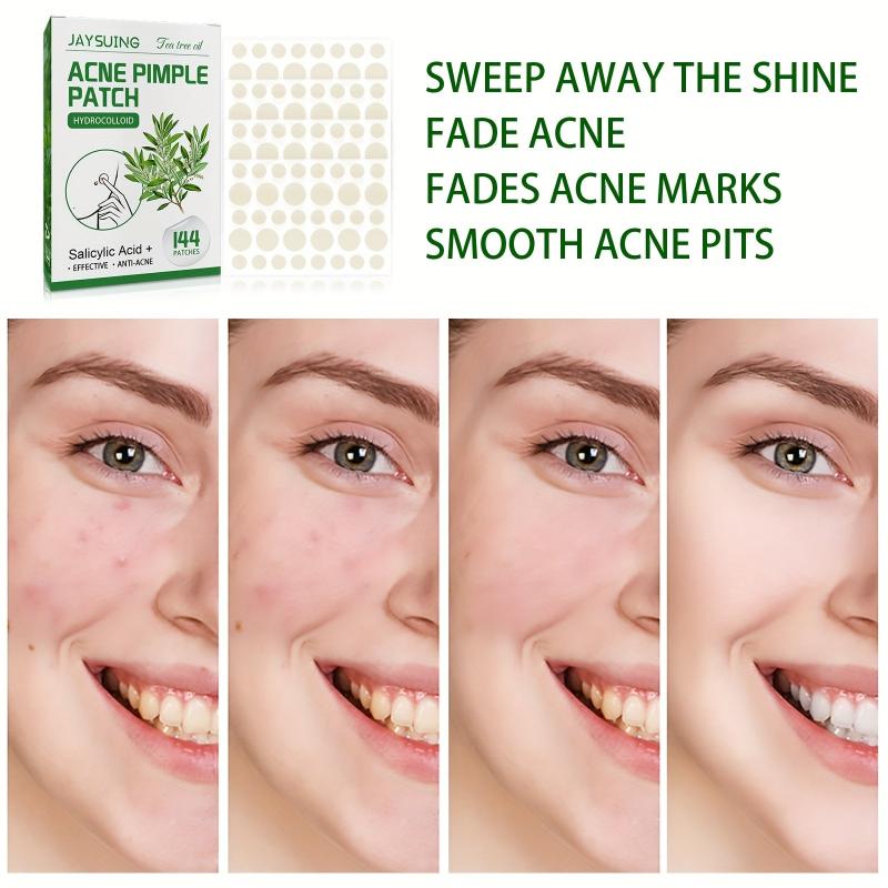 Tea Tree Acne Patch Invisible Makeup Acne Patch Closed Acne Repair