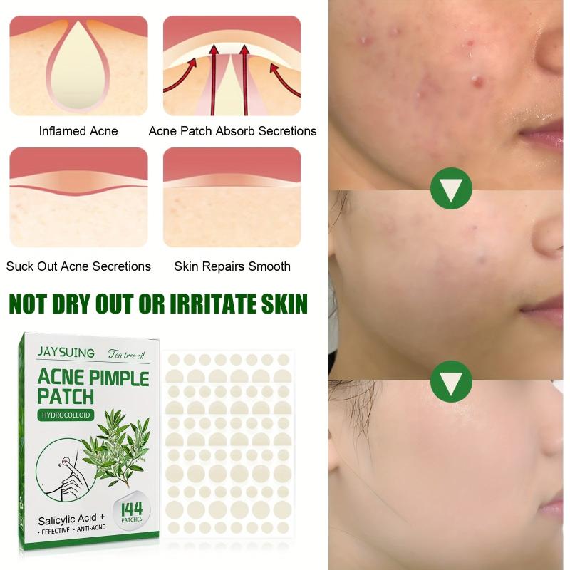 Tea Tree Acne Patch Invisible Makeup Acne Patch Closed Acne Repair