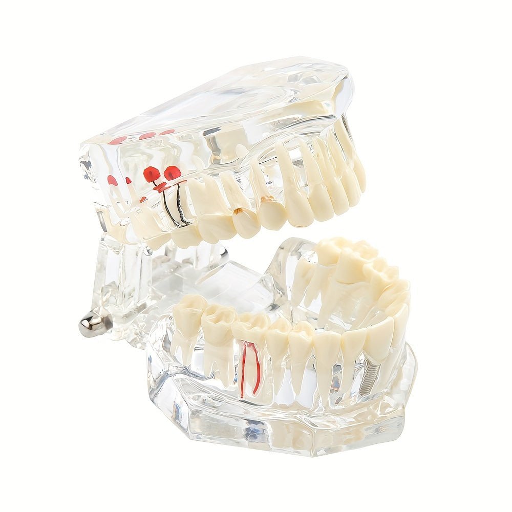 Dental Restoration Model Pathological Tooth Model Implant Tooth Model
