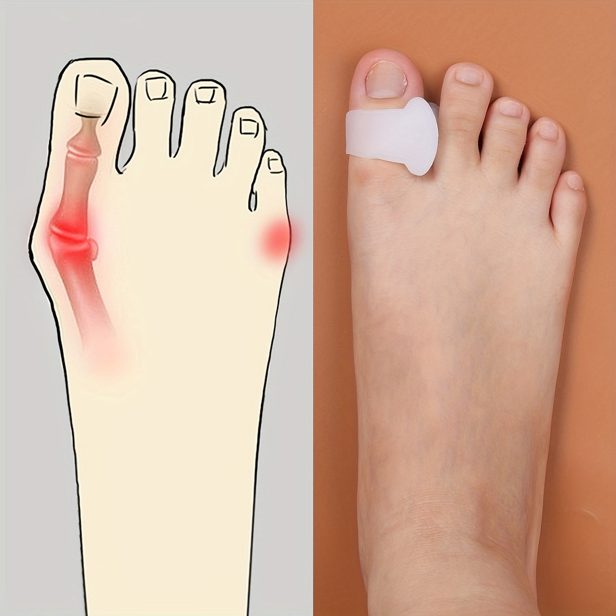 Translucent Gel Toe Separators for Toe Separation Correction